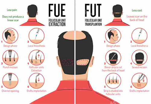 FUE植发和FUT植发对比图