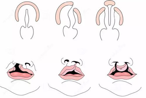 唇腭裂的图片