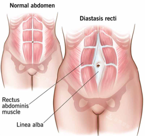 腹壁成型前后对比