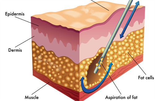 吸脂过程图解