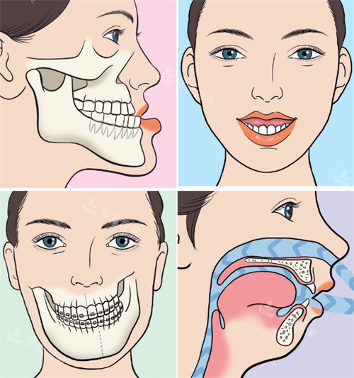 正颌整形手术前后对比图