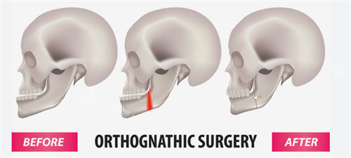 下颌角整形手术过程