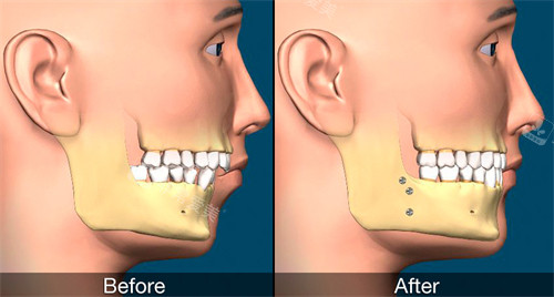 正颌手术改善地包天