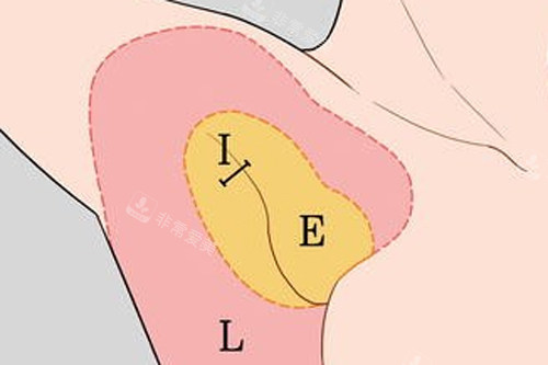 副乳位置图解