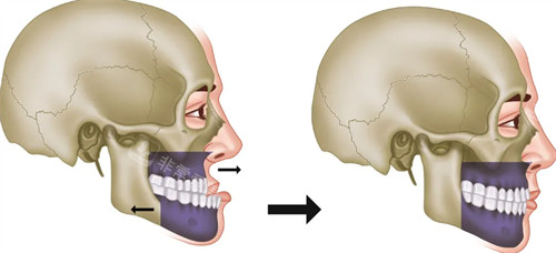 地包天在正颌手术后的前后对比