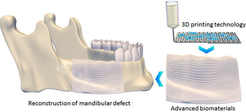 3D打印技术修复下颌缺损骨骼