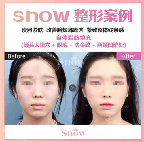 韩国SNOW整形外科正面对比图