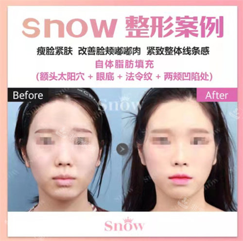 韓國SNOW整形外科正面對比圖