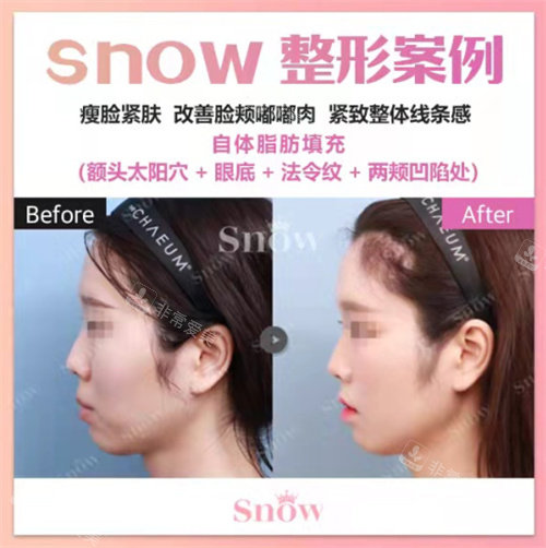 韩国SNOW整形外科侧面对比图