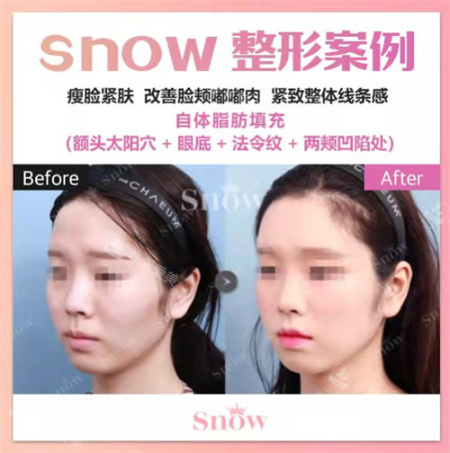 韩国SNOW整形外科脂肪填充前后对比图