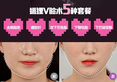 韓國愛她整形外科狐貍V臉術(shù)前后照片對(duì)比