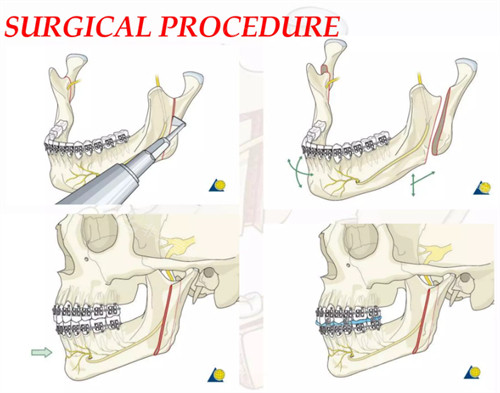 削骨手术全过程