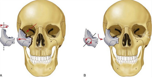 改善颧骨的手术方式