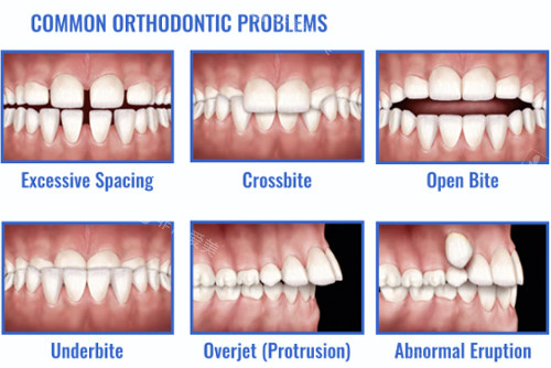常见的牙齿畸形问题图解