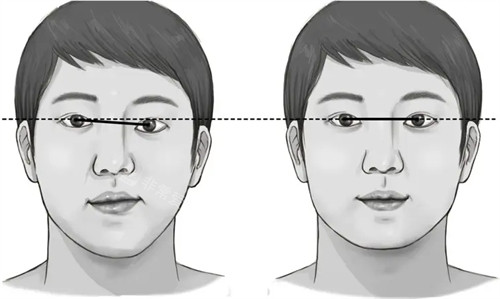 下颌骨高低不平矫正前后对比