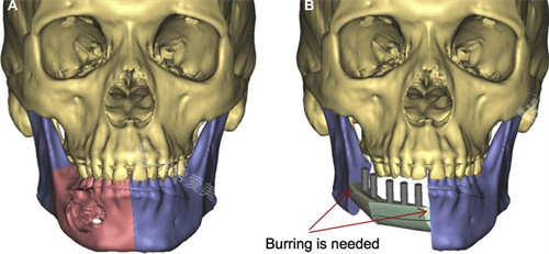 下颌骨修复前后对比