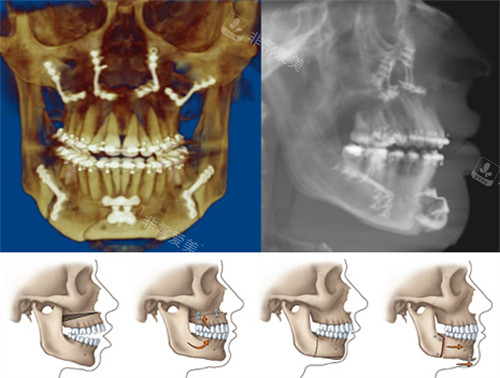 正颌手术前后对比