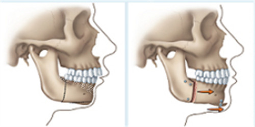 骨性龅牙在正颌手术后的前后对比