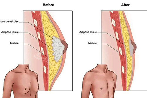 男性吸脂缩胸手术图解