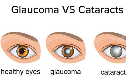 不同程度青光眼的样子图解