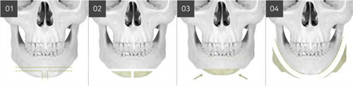 下巴截骨的手术方式