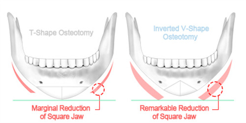 下颌角手术截骨方式