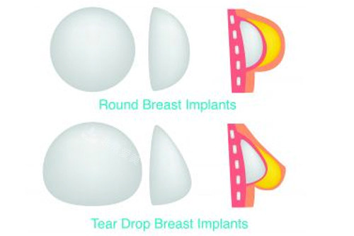 不同形态假体隆胸后胸部形态图解