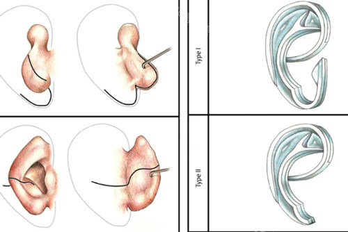 人工材料耳再造手术过程图解