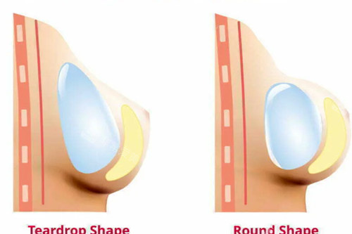 不同形态假体隆胸后胸部的形态图解
