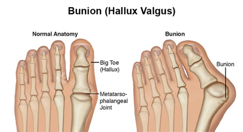 拇外翻和正常脚的对比