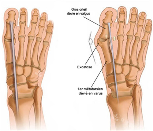 大脚骨和正常骨头的对比