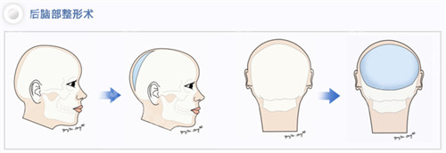 后脑勺填充的前后对比
