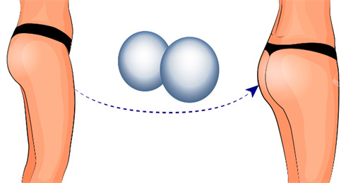 臀部填充假体前后对比