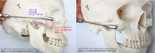 3S颧骨手术前后模型对比示意图