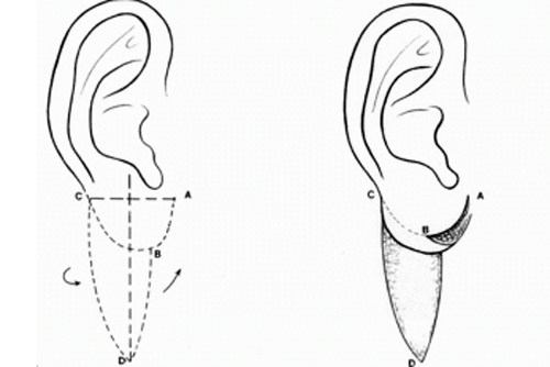 耳垂再造手术过程图解
