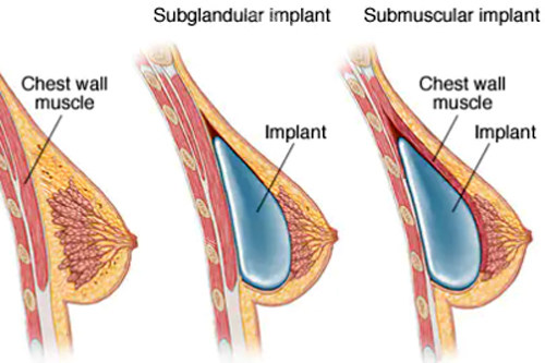 假体隆胸植入体内的位置图解