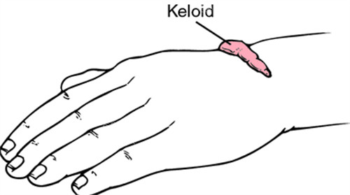 身上出现疤痕出现增生或疙瘩的情况