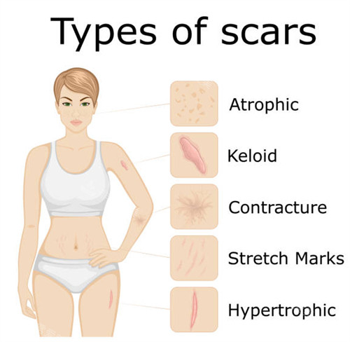 各种疤痕类型