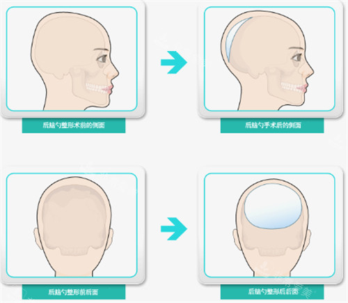 后脑勺填充过程和前后对比