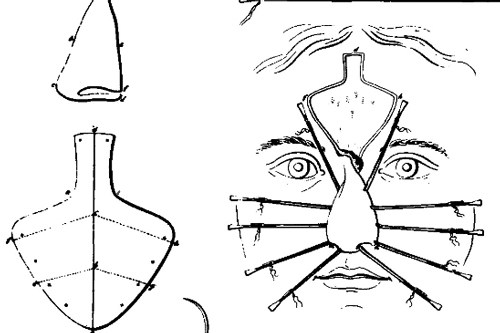 全鼻再造手术过程图解