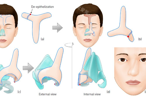 额部皮瓣全鼻再造手术过程图解
