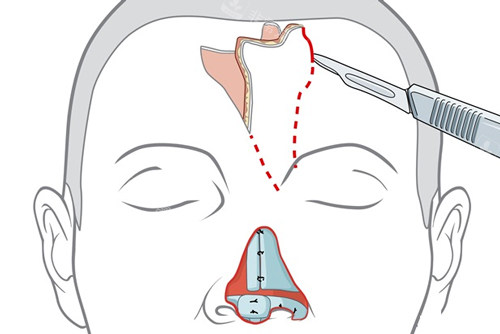 鼻再造手术过程图解