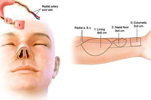 手臂皮瓣全鼻再造手术过程图解