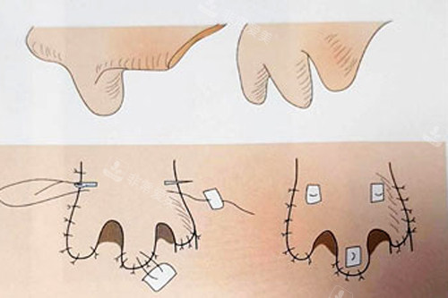 鼻再造手术过程图解