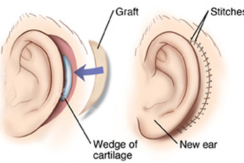 全耳再造手术过程图解