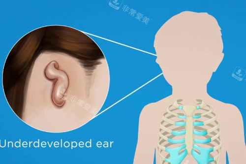 耳再造取自体肋软骨的位置图解