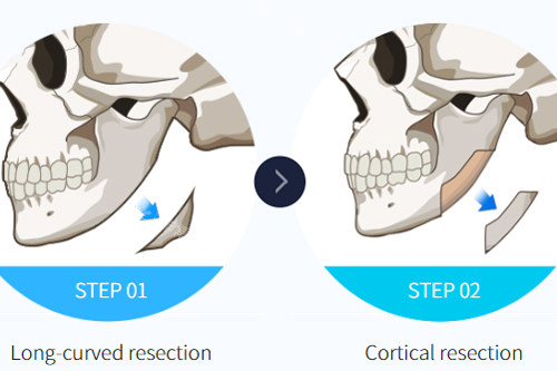 不同下颌角截骨手术的区别图解