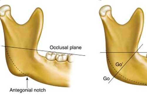 不同种类的下颌角问题图解