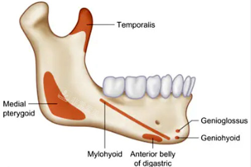 下颌角手术部位图解