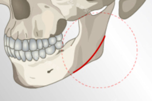 下颌角截骨手术切除部位图解